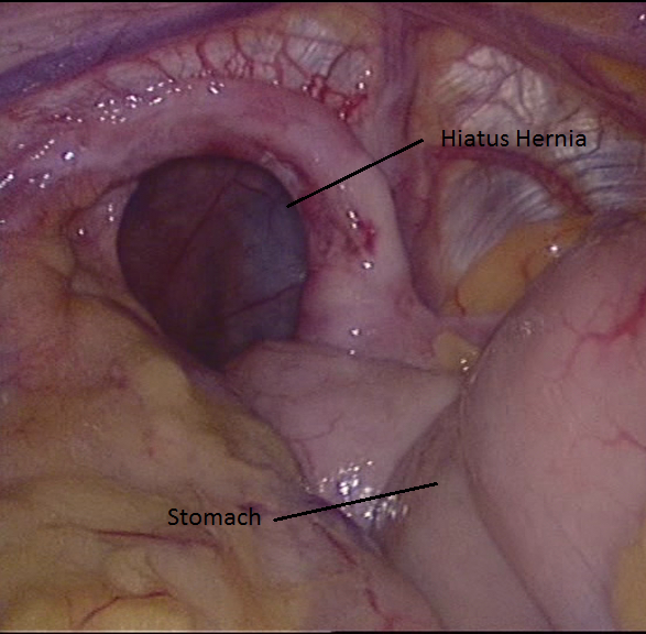 Admin/uploads/11_06_201810_23Para Esophageal Hiatus Hernia.png